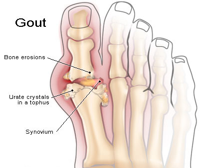 النقرص - Gout 251